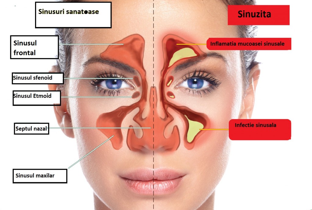 Sinuzita 1024x689